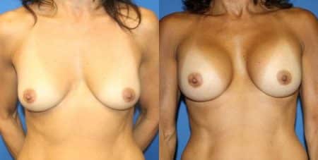 patient-11069-breast-augmentation-before-after