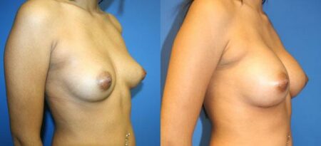 patient-11080-breast-augmentation-before-after-1