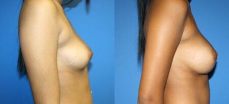 patient-11080-breast-augmentation-before-after-2