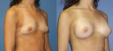 patient-11087-breast-augmentation-before-after-1