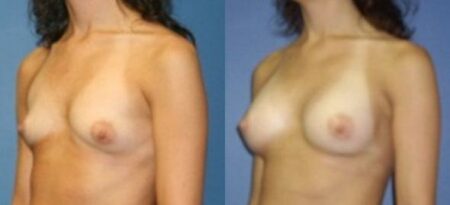 patient-11087-breast-augmentation-before-after-2