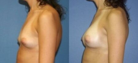 patient-11087-breast-augmentation-before-after-3