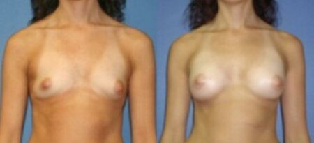 patient-11087-breast-augmentation-before-after