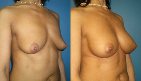 patient-11107-breast-augmentation-before-after-1