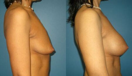 patient-11107-breast-augmentation-before-after-2