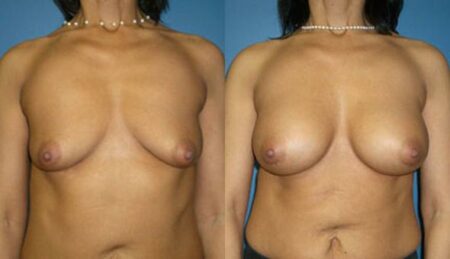 patient-11107-breast-augmentation-before-after