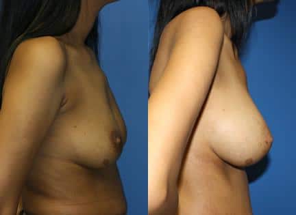patient-11114-breast-augmentation-before-after-1