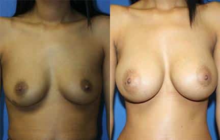 patient-11114-breast-augmentation-before-after