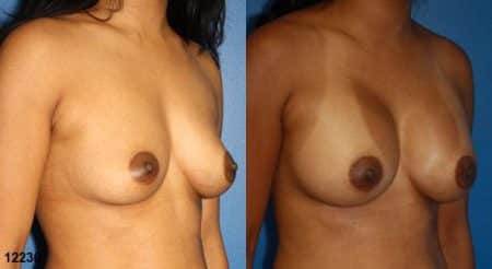 patient-11131-breast-augmentation-before-after-1