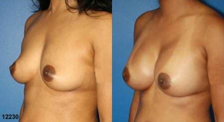 patient-11131-breast-augmentation-before-after-3