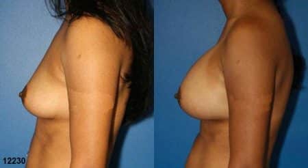 patient-11131-breast-augmentation-before-after-4