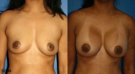 patient-11131-breast-augmentation-before-after