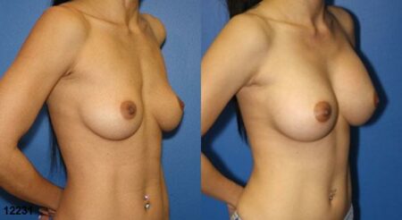 patient-11142-breast-augmentation-before-after-1