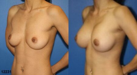 patient-11142-breast-augmentation-before-after-3