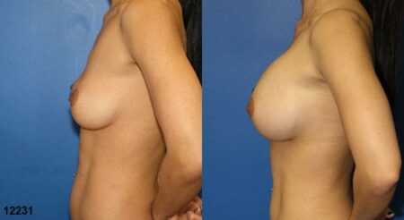 patient-11142-breast-augmentation-before-after-4