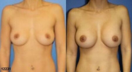 patient-11142-breast-augmentation-before-after