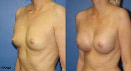 patient-11153-breast-augmentation-before-after-1