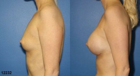 patient-11153-breast-augmentation-before-after-2