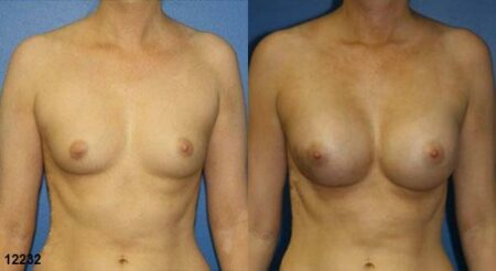 patient-11153-breast-augmentation-before-after