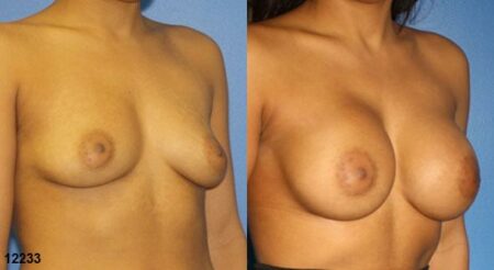 patient-11160-breast-augmentation-before-after-1