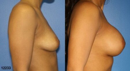 patient-11160-breast-augmentation-before-after-2