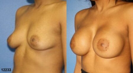 patient-11160-breast-augmentation-before-after-3