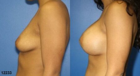 patient-11160-breast-augmentation-before-after-4