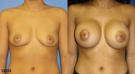 patient-11160-breast-augmentation-before-after