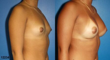 patient-11171-breast-augmentation-before-after-1