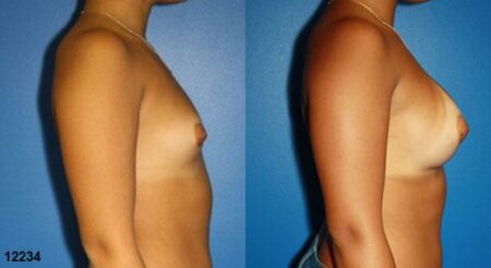 patient-11171-breast-augmentation-before-after-2