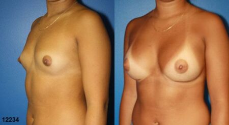 patient-11171-breast-augmentation-before-after-3