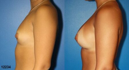 patient-11171-breast-augmentation-before-after-4