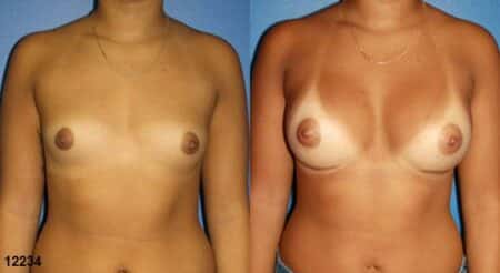 patient-11171-breast-augmentation-before-after