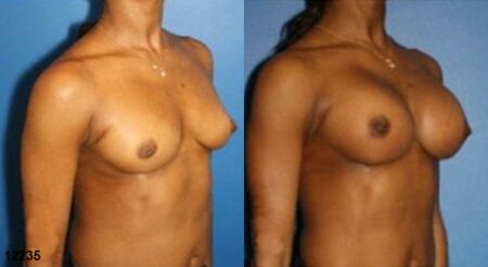 patient-11182-breast-augmentation-before-after-1