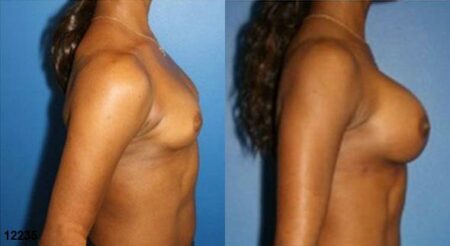 patient-11182-breast-augmentation-before-after-2