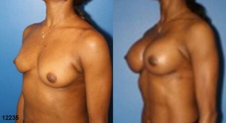 patient-11182-breast-augmentation-before-after-3