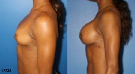 patient-11182-breast-augmentation-before-after-4