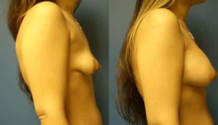 patient-11193-breast-irregularities-before-after-2