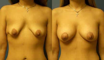 patient-11193-breast-irregularities-before-after