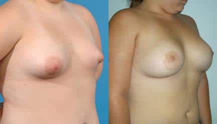 patient-11200-breast-irregularities-before-after-1