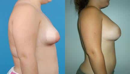 patient-11200-breast-irregularities-before-after-2