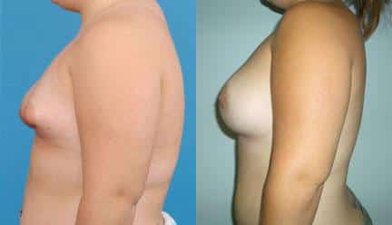 patient-11200-breast-irregularities-before-after-4