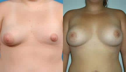 patient-11200-breast-irregularities-before-after