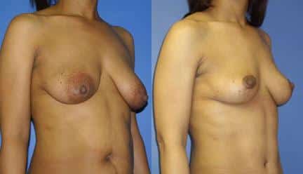 patient-11211-breast-lift-before-after-1