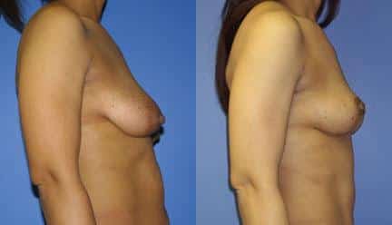 patient-11211-breast-lift-before-after-2