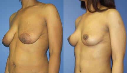 patient-11211-breast-lift-before-after-3