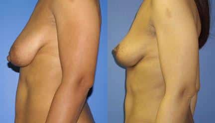 patient-11211-breast-lift-before-after-4