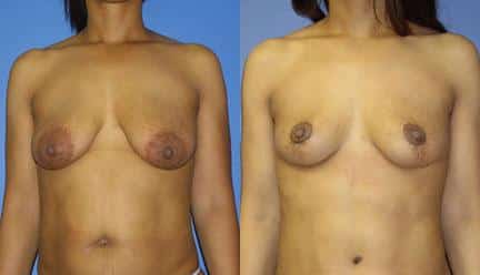 patient-11211-breast-lift-before-after