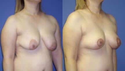 patient-11222-breast-lift-before-after-1