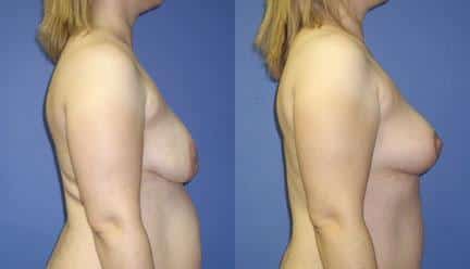 patient-11222-breast-lift-before-after-2